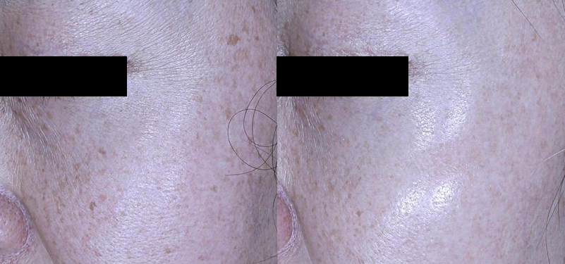 240524_241022_포텐자+쥬베룩+레이저 (2)