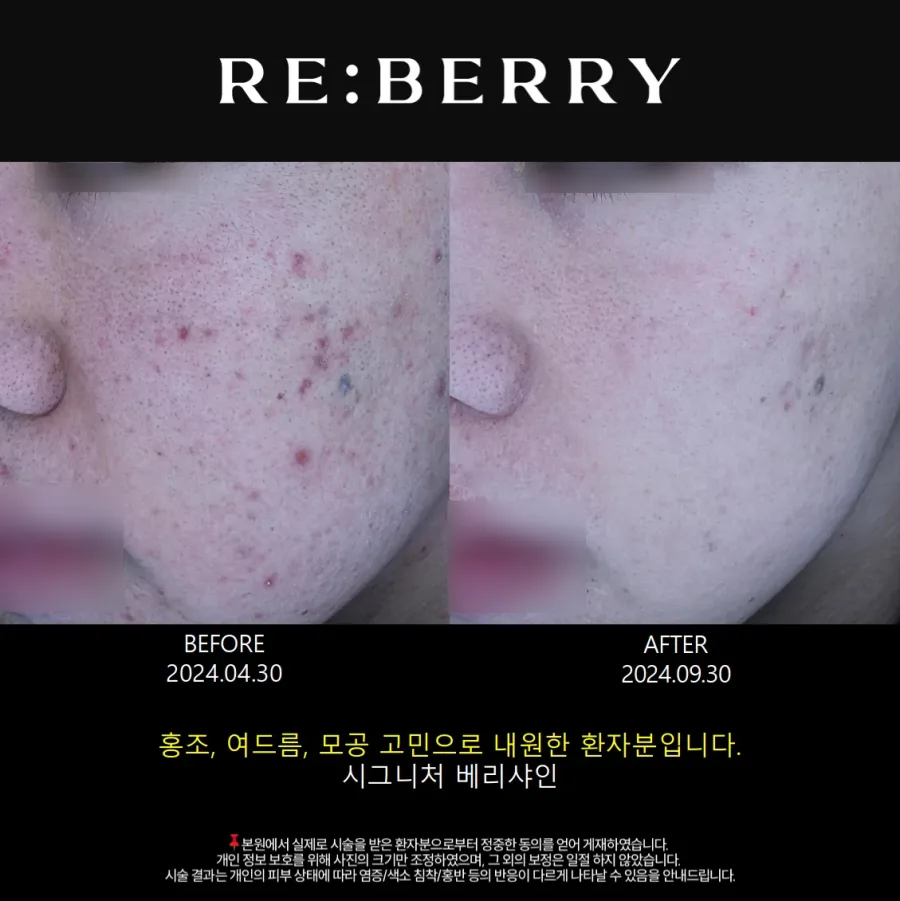 베리샤인 토닝 시술 전후