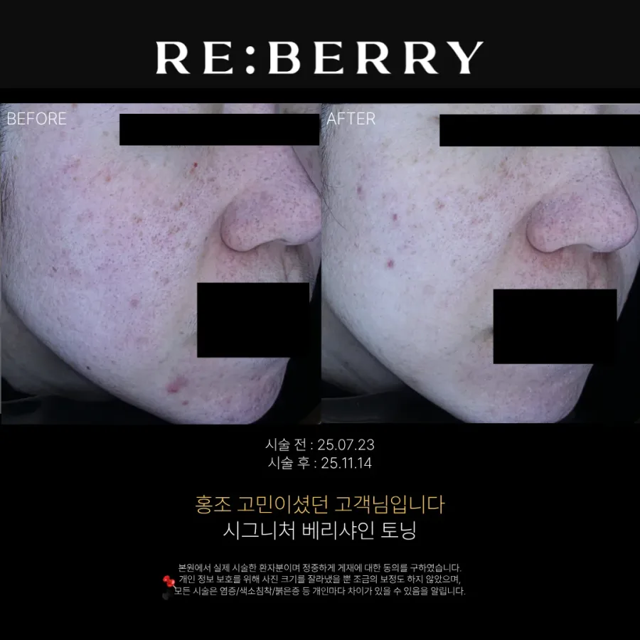 베리샤인 토닝 시술 전후