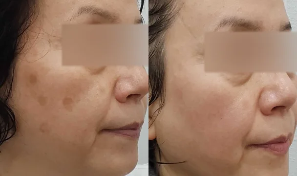 피코슈어 토닝 시술 전후